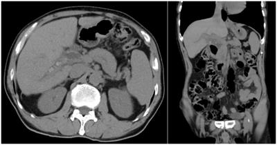 Case report: How I do it? Laparoscopic hepatectomy with transcatheter arterial ICG staining for hepatolithiasis review